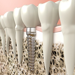 Traditional dental implant next to natural teeth