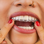 Closeup of woman putting on clear aligner