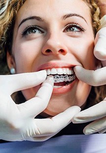 Dentist placing clear aligners on woman's teeth
