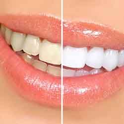 Before and after teeth whitening